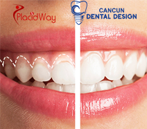 Slider image (9) Cancun Dental Design
